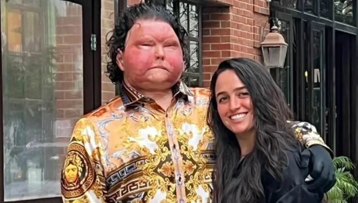 Dünya’da birinci kere birebir şahıstan hem yüz hem de çift el nakli yapılan adam nişanlandı