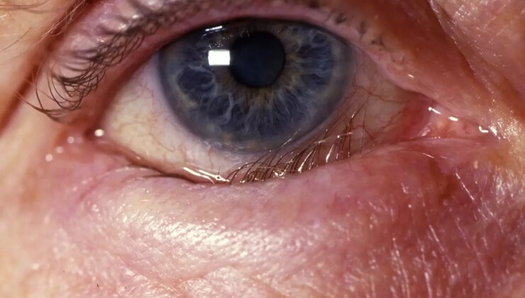 Kirpikler Gözünüze Batıyorsa Dikkat: Trikiyazis Göz Sıhhatini Tehdit Ediyor